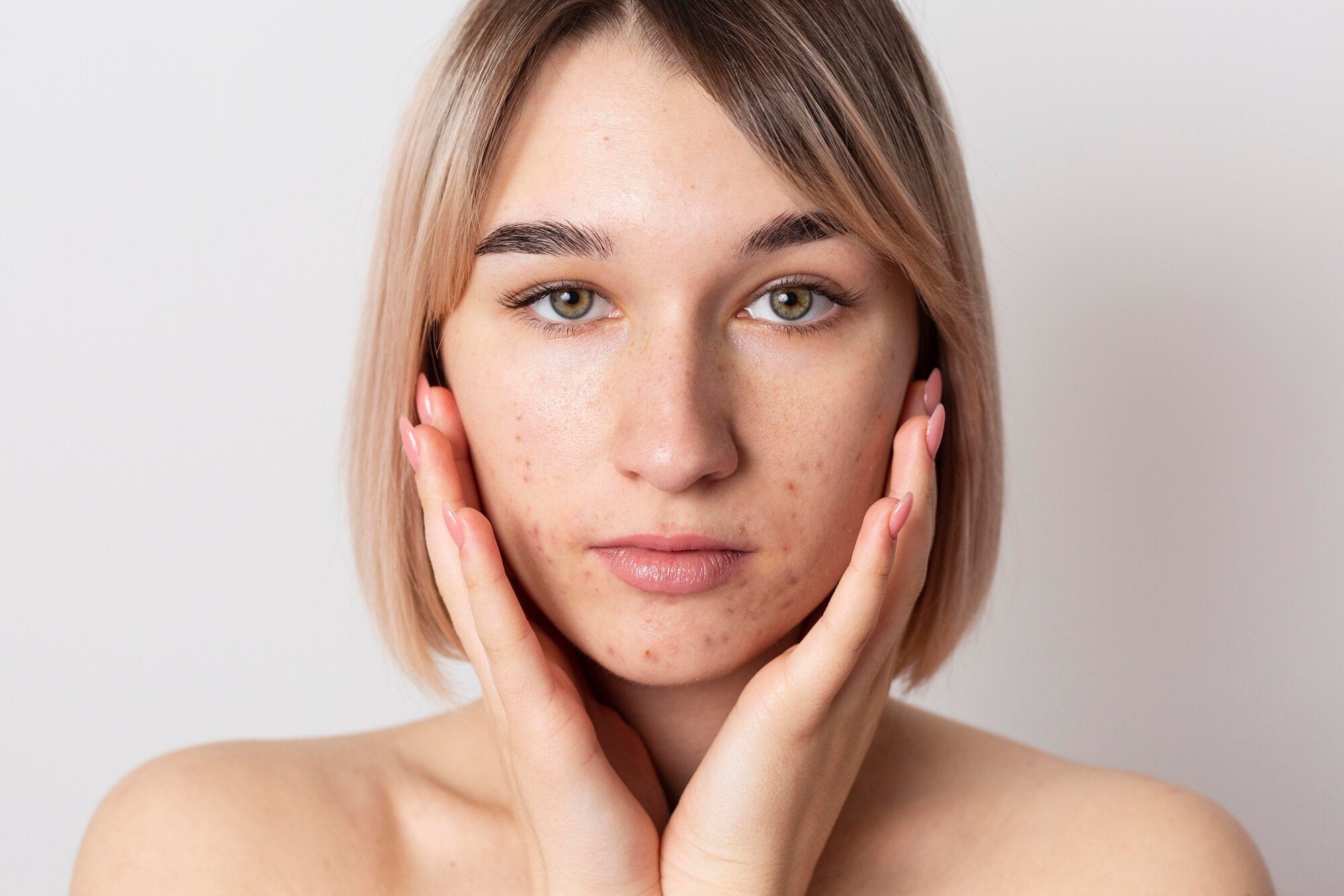 Acne-prone skin